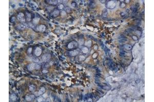 Formalin-fixed and paraffin embedded human colorectal cancer labeled with Anti-ELAVL1/HUR Polyclonal Antibody, Unconjugated (ABIN748583) followed by conjugation to the secondary antibody and DAB staining