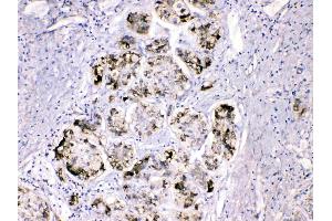 FGG was detected in paraffin-embedded sections of human liver cancer tissues using rabbit anti- FGG Antigen Affinity purified polyclonal antibody (Catalog # ) at 1 µg/mL.