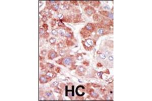 Formalin-fixed and paraffin-embedded human cancer tissue reacted with the primary antibody, which was peroxidase-conjugated to the secondary antibody, followed by AEC staining. (GRK7 anticorps  (C-Term))