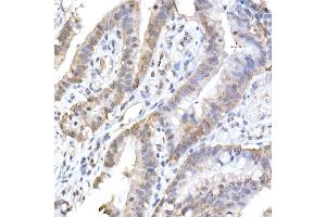 Immunohistochemistry of paraffin-embedded human colon carcinoma using HINT1 Rabbit mAb (ABIN7267663) at dilution of 1:50 (40x lens). (HINT1 anticorps)