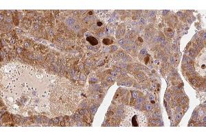 ABIN6276856 at 1/100 staining Human liver cancer tissue by IHC-P. (Fc epsilon RI/FCER1A anticorps  (C-Term))
