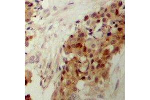 Immunohistochemical analysis of p38 (pY182) staining in human breast cancer formalin fixed paraffin embedded tissue section.