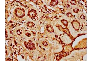 IHC image of nacHU diluted at 1:20 and staining in paraffin-embedded human breast cancer performed on a Leica BondTM system.