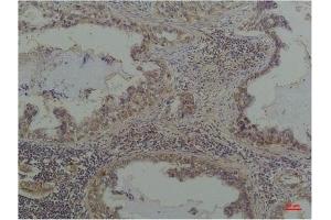 Immunohistochemical analysis of paraffin-embedded Human Lung Caricnoma using Phosphoserine Mouse mAb diluted at 1:200. (Phosphoserine anticorps)
