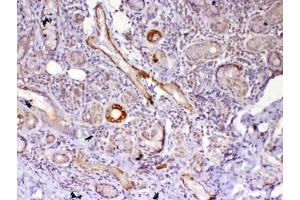 IHC testing of FFPE human lung cancer tissue with FZD4 antibody at 1ug/ml.