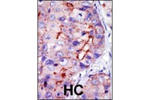 Formalin-fixed and paraffin-embedded human cancer tissue reacted with the primary antibody, which was peroxidase-conjugated to the secondary antibody, followed by DAB staining. (CAMK1D anticorps  (C-Term))
