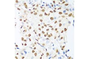 Immunohistochemistry of paraffin-embedded human prostate cancer using HDAC1 antibody. (HDAC1 anticorps  (AA 393-482))