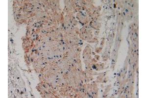 IHC-P analysis of Human Stomach Cancer Tissue, with DAB staining. (PLA2G4A anticorps  (AA 563-749))
