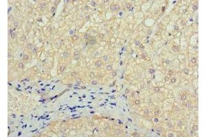Immunohistochemistry of paraffin-embedded human liver cancer using ABIN7172606 at dilution of 1:100 (SOX14 anticorps  (AA 1-137))