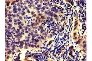 IHC image of ABIN7142292 diluted at 1:200 and staining in paraffin-embedded human pancreatic cancer performed on a Leica BondTM system. (HMGCR anticorps  (AA 588-887))