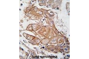 Formalin-fixed and paraffin-embedded human lung carcinoma tissue reacted with Phospho-RGS19-p. (RGS19 anticorps  (AA 131-156))