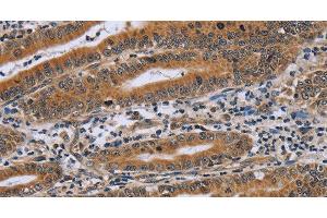 Immunohistochemistry of paraffin-embedded Human gastric cancer using NDUFAF4 Polyclonal Antibody at dilution of 1:45 (NDUFAF4 anticorps)