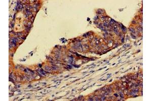 Immunohistochemistry of paraffin-embedded human colon cancer using ABIN7162911 at dilution of 1:100