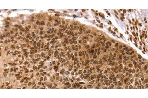 Immunohistochemistry of paraffin-embedded Human esophagus cancer using TAF10 Polyclonal Antibody at dilution of 1:35