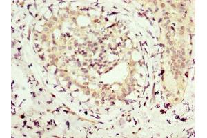 IHC image of ABIN7154254 diluted at 1:300 and staining in paraffin-embedded human breast cancer performed on a Leica BondTM system. (NMT1 anticorps  (AA 1-158))