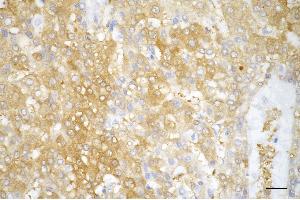 Immunohistochemistry was performed on paraffin-embedded human hepatocarcinoma using acetyl-CoA acetyltransferase 2 antibody (ABIN7797440), 1:200).