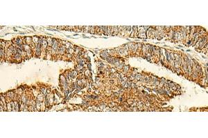 Immunohistochemistry of paraffin-embedded Human colorectal cancer tissue using IFT27 Polyclonal Antibody at dilution of 1:50(x200) (RABL4 anticorps)