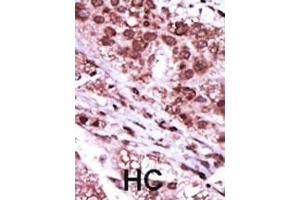 Formalin-fixed and paraffin-embedded human cancer tissue reacted with the primary antibody, which was peroxidase-conjugated to the secondary antibody, followed by DAB staining.