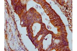 IHC image of ABIN7154052 diluted at 1:500 and staining in paraffin-embedded human colon cancer performed on a Leica BondTM system.