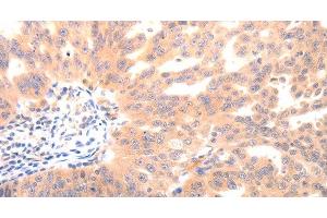 Immunohistochemistry of paraffin-embedded Human ovarian cancer using BGLAP Polyclonal Antibody at dilution of 1:40 (Osteocalcin anticorps)
