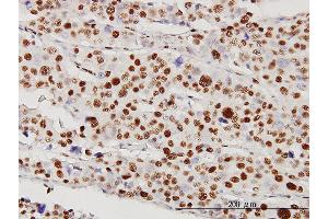 Immunoperoxidase of monoclonal antibody to STK38 on formalin-fixed paraffin-embedded human malignant lymphoma, diffuse large B tissue [antibody concentration 5 ug/ml]