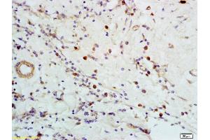 Formalin-fixed and paraffin embedded human breast carcinoma labeled with Anti-CXCR5 Polyclonal Antibody, Unconjugated (ABIN701380) at 1:200 followed by conjugation to the secondary antibody and DAB staining (CXCR5 anticorps  (AA 281-372))
