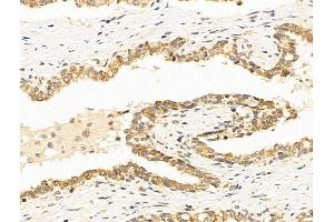 ABIN7094772 and ABIN7098823 at 1/100 staining Human colorectal cancer by IHC-P.