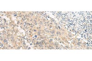 Immunohistochemistry of paraffin-embedded Human cervical cancer tissue using GPR22 Polyclonal Antibody at dilution of 1:50(x200) (GPR22 anticorps)