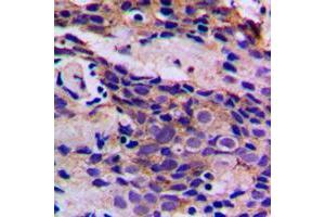 Immunohistochemical analysis of CDK5 (pY15) staining in human breast cancer formalin fixed paraffin embedded tissue section.