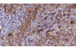 ABIN6276857 at 1/100 staining Human liver cancer tissue by IHC-P. (CD3 epsilon anticorps  (C-Term))