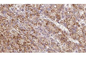 ABIN6279610 at 1/100 staining Human liver cancer tissue by IHC-P. (CHRNB4 anticorps  (Internal Region))