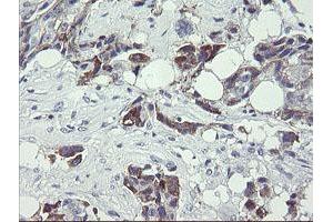 Immunohistochemical staining of paraffin-embedded Adenocarcinoma of Human breast tissue using anti-TDO2 mouse monoclonal antibody. (TDO2 anticorps)