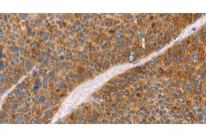 Immunohistochemistry of paraffin-embedded Human liver cancer using FGL1 Polyclonal Antibody at dilution of 1:50