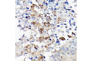 Immunohistochemistry of paraffin-embedded human lung cancer using CD68 Rabbit pAb (ABIN6132070, ABIN6138218, ABIN6138221 and ABIN6217224) at dilution of 1:50 (40x lens).