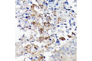 Immunohistochemistry of paraffin-embedded human lung cancer using CD68 Rabbit pAb (ABIN6132070, ABIN6138218, ABIN6138221 and ABIN6217224) at dilution of 1:50 (40x lens). (CD68 anticorps  (AA 22-319))
