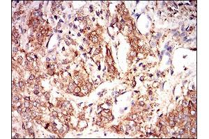 Immunohistochemical analysis of paraffin-embedded bladder cancer tissues using EIF2A mouse mAb with DAB staining. (EIF2A anticorps  (AA 448-576))