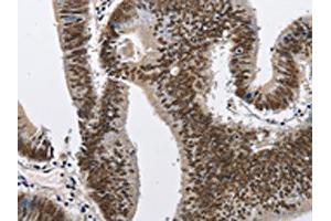 The image on the left is immunohistochemistry of paraffin-embedded Human colon cancer tissue using ABIN7128978(CMTM2 Antibody) at dilution 1/60, on the right is treated with fusion protein. (CMTM2 anticorps)