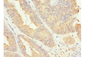 Immunohistochemistry of paraffin-embedded human endometrial cancer using ABIN7167233 at dilution of 1:100