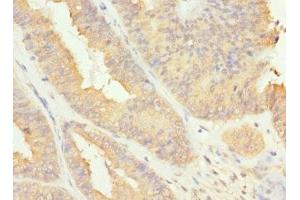 Immunohistochemistry of paraffin-embedded human endometrial cancer using ABIN7167233 at dilution of 1:100 (RAB17 anticorps  (AA 1-212))