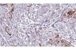ABIN6277621 at 1/100 staining Human urothelial cancer tissue by IHC-P.