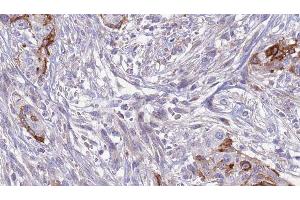 ABIN6277621 at 1/100 staining Human urothelial cancer tissue by IHC-P. (SLC3A1 anticorps  (C-Term))