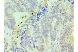 Immunohistochemistry of paraffin-embedded human colon cancer using ABIN7156999 at dilution of 1:100 (IFT57 anticorps  (AA 170-429))