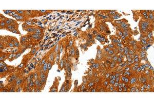 Immunohistochemistry of paraffin-embedded Human ovarian cancer using CAP2 Polyclonal Antibody at dilution of 1:50