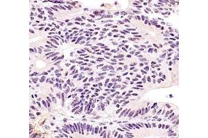 Immunohistochemistry of paraffin embedded human colon cancer using ZKSCAN4 (ABIN7076265) at dilution of 1:400 (400x lens) (ZKSCAN4 anticorps)