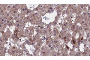 ABIN6277501 at 1/100 staining Human liver cancer tissue by IHC-P. (CHRNB1 anticorps  (N-Term))