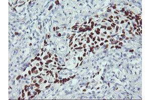 Immunohistochemical staining of paraffin-embedded Carcinoma of Human lung tissue using anti-TP53 mouse monoclonal antibody. (p53 anticorps)