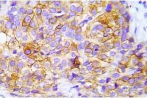 Immunohistochemistry (IHC) analyzes of p-CrkL (Try207) antibody in paraffin-embedded human lung adenocarcinoma tissue. (CrkL anticorps  (pTyr207))