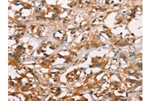 The image on the left is immunohistochemistry of paraffin-embedded Human thyroid cancer tissue using ABIN7189818(ANXA2R Antibody) at dilution 1/25, on the right is treated with synthetic peptide. (Chromosome 5 Open Reading Frame 39 (C5orf39) anticorps)