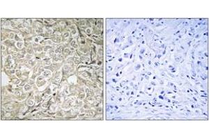 Immunohistochemistry analysis of paraffin-embedded human prostate carcinoma tissue, using RAB37 Antibody. (RAB37 anticorps  (AA 170-219))