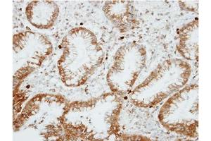 Immunohistochemical analysis of Paraffin-Embedded GASTRIC CA, using AP31129PU-N RGS14 antibody at 1/100 dilution.